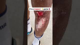 Skating Race Accident 🤕 #skate #skating #youtube #youtubeshorts #shortsvideo #sport #india