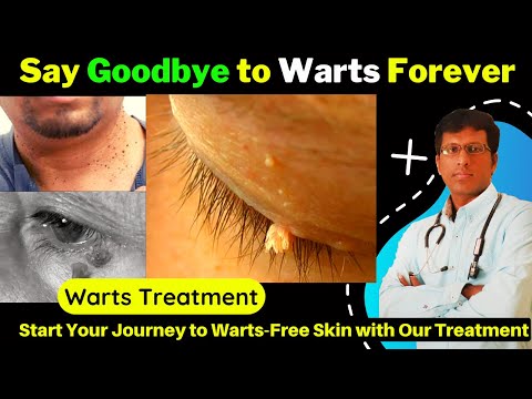 Revolutionary Warts Treatment: Say Goodbye to Warts Forever!