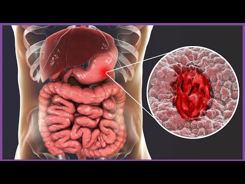 Treating the Root Cause: IBS, IBD & SIBO Explained by Gut Health Experts