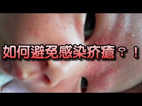 如何避免感染疥瘡？！