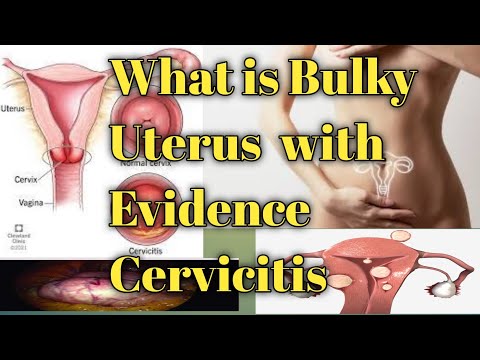 What is Bulky Uterus  with Evidence Cervicitis How to treatment Bulky Uterus withevidence cervicitis