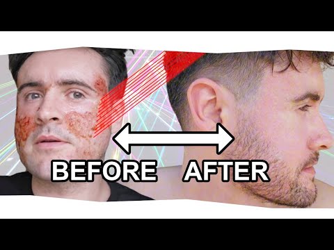 C02 Laser Before After Acne Scars Results - 13 Day Scar Removal Laser