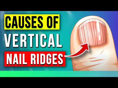 The SHOCKING Causes of VERTICAL RIDGES On Your Nails