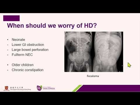 Hirschsprung Disease by Dr. Vicky Wong