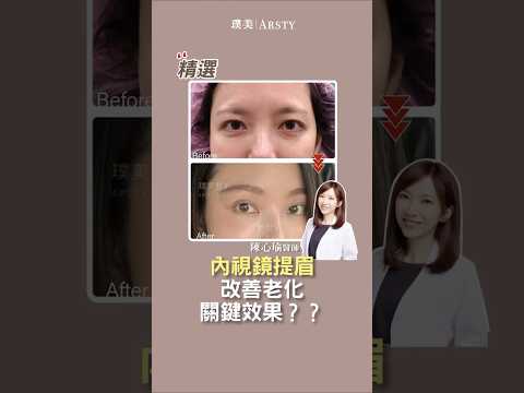 精選｜【內視鏡提眉#2】內視鏡提眉改善老化關鍵效果？#璞美#陳心瑜醫師#川字紋#皺眉#年輕化#拉皮