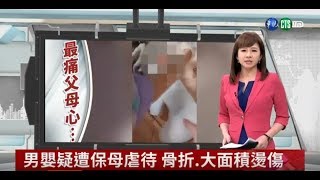 男童疑遭保母虐待 骨折 大面積燙傷