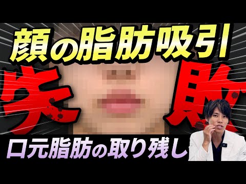 【脂肪吸引の修正手術】口元がスッキリしない “ジョールファット、バッカルファットの取り残し”を修正。顔の脂肪吸引のよくある失敗例