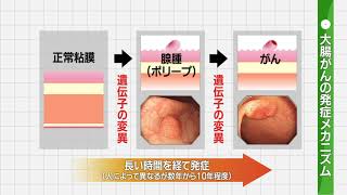 大腸がんの早期発見について考える