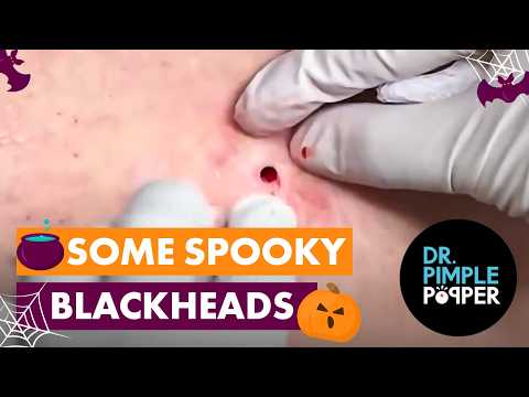 Some Spooky Blackheads