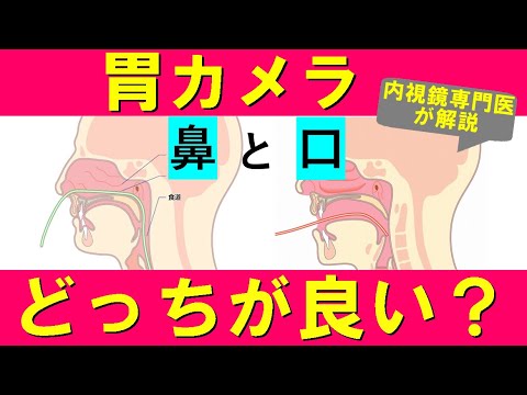 【胃カメラ】鼻からと口から、どちらがオススメ？内視鏡専門医が解説。