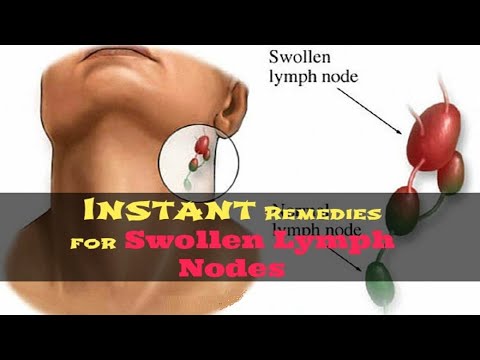 How to Get Rid of Swollen Lymph Nodes Naturally | 5 Remedies for Swollen Lymph Nodes in Neck.