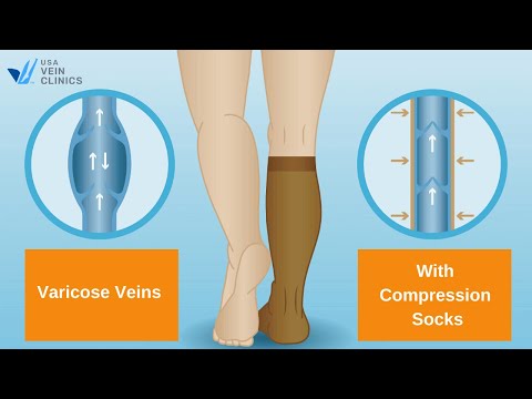 The Benefits of Vein  Compression Socks