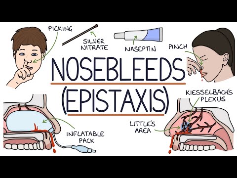 Understanding Nosebleeds (Epistaxis)