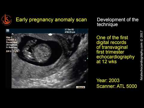 Fetal echocardiography at 11-13 weeks: How It Was Possible to Do in 2003