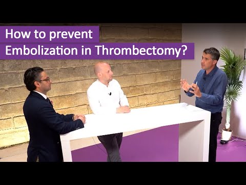 Confronting embolization in thrombectomy: confirmations and revelations.