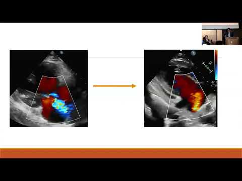 Invasive Hemodynamics and Role for Catheter Based Interventions - Jamil Aboulhosn, MD