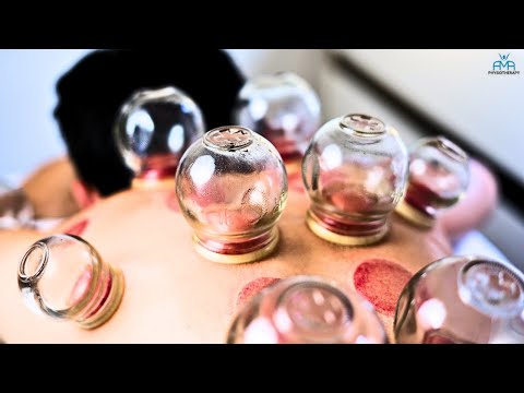 Debunking Cupping: Does It Really Work? | The Truth Revealed