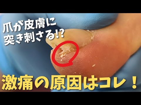 【爪が皮膚に突き刺さった巻き爪】山形県 寒河江巻き爪フットケアセンター　陥入爪、割れ爪も対応可能