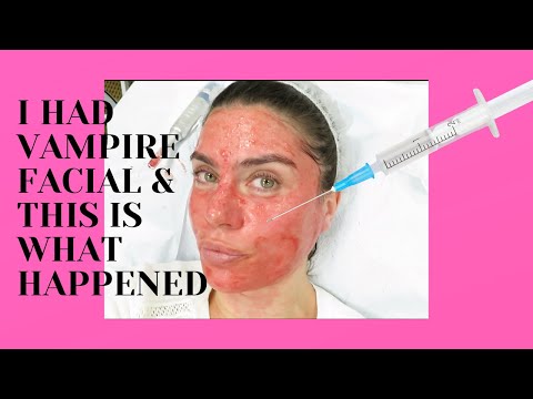 I HAD A VAMPIRE FACIAL AND THIS IS WHAT HAPPENED