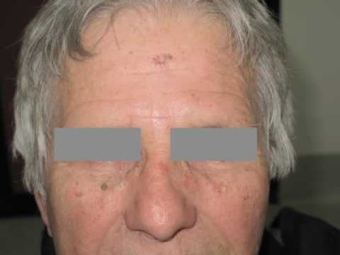 Pigmentation in a scar by Dr. Elvira Moscarella