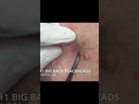 Dr Pimple Popper's Throwback Pops