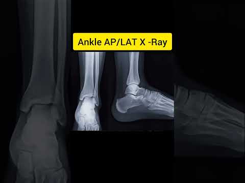 Ankle X -ray