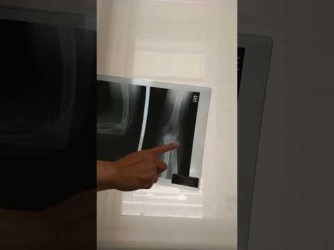 肘の脱臼骨折について　春日部　ときだ接骨院鍼灸院 elbow fracture Xray