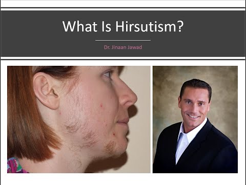 What Is Hirsutism?  Facial Hair