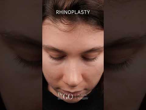 Rhinoplasty Transformation by Assoc. Prof. Dr. Güncel Öztürk | Before & After Results