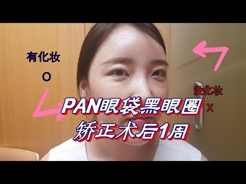 香香小姐的黑眼圈矯正日記5. PAN眼袋黑眼圈矯正術后第7天變漂亮了很多哦