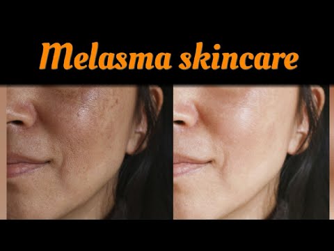 Melasma skincare routine ! hyperpigmentation