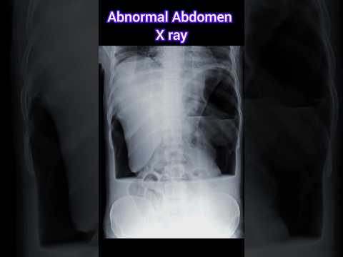 Abnormal Abdomen X ray