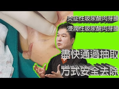 玻尿酸肉芽腫中炎症性和浸潤性玻尿酸肉芽腫