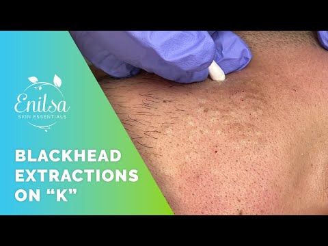 Blackhead Extrations on "K" - He's back!