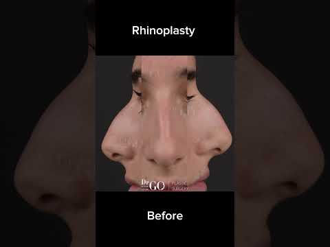 Before and after Rhinoplasty - Dr Guncel Ozturk #beforeandafter #rhinoplastyturkey #drgo #nosejob