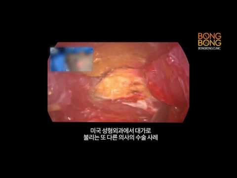 미국성형외과 또다른 전문의의 수술영상 공개!