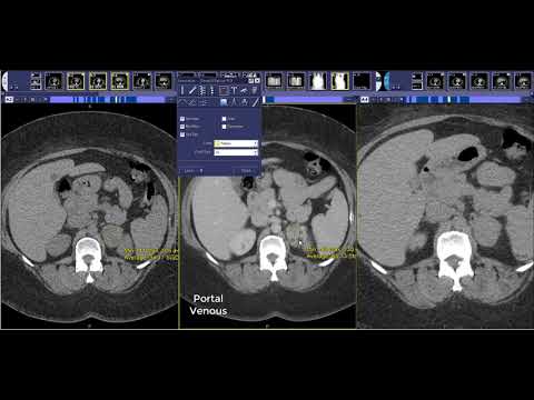 How to read an adrenal protocol CT scan - adrenal washout