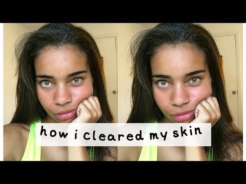 my skincare routine🦋 // how i cleared my acne