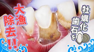 牡蠣化歯石を大量除去！！Removes oyster-like tartar🦪