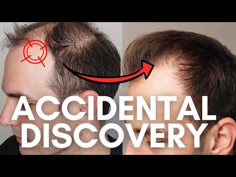 NEW Hair Growth Experiment - Better Than Minoxidil & Finasteride!