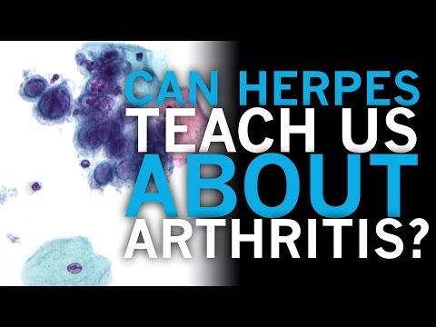 Can Herpes Teach Us About Arthritis?