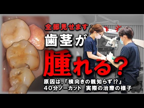 【全部見せます】歯茎に溜まった膿を抜く！原因は『横向の親知らず？』４０分ノーカット　#フィステル　#親知らず