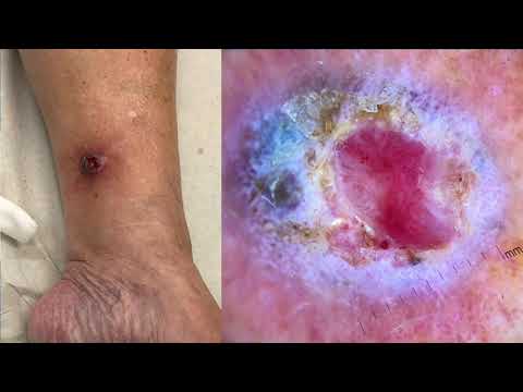 Invasive vs in situ melanoma - Dr John PAOLI