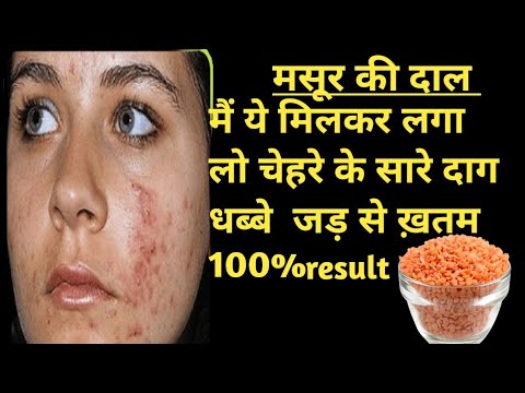 मसूर की दाल का ऐसा फेस पैक जो चेहरे के pimples  , pigmentation दाग धब्बे हटाये , glowing, चमकदार ski