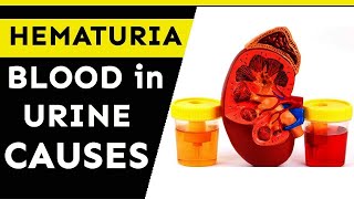 Hematuria: causes and evaluation of blood in your urine | Nature Cure Fit