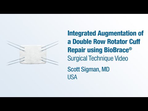 Integrated Augmentation of a Double Row Rotator Cuff Repair using BioBrace®  - CONMED Technique