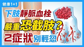 下肢靜脈血栓 有哪些 症狀 ？ | 腿腫 、 腿痛  是下肢靜脈 血栓 嗎？ 和 靜脈曲張 區別？| 健康1+1