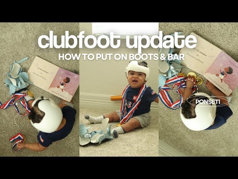 How to put on PONSETI Boots & Bar | Clubfoot Journey Update 1 Year Later