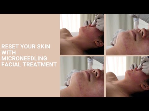 Reset Your Skin With Microneedling Facial Treatment