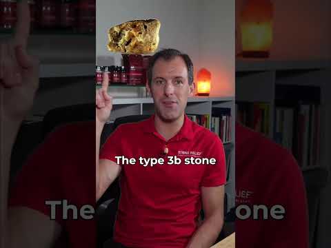 4 subtypes of uric acid stones